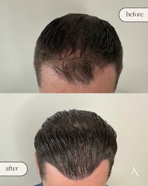 Een geslaagde haartransplantatie draait niet alleen om het terugbrengen van haar.
Het draait om het 