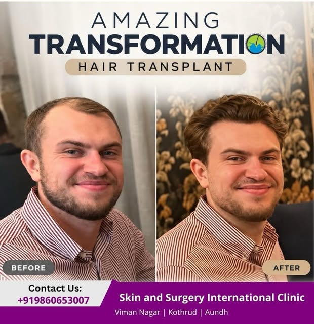 The smile says it all. 
He travelled all the way from the USA to Pune for his hair transplant with D