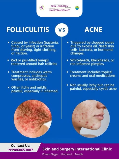 Acne or folliculitis? Over-moisturizing or the wrong moisturizer?

These common skin concerns often 