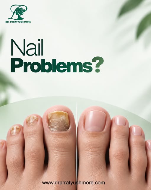 Nail problems can be more than just a cosmetic concern. Changes in nail colour, texture, thickness, 