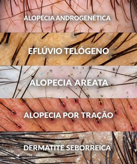 Nem toda queda de cabelo é igual, e entender a causa faz toda diferença no tratamento.

Alopecia and