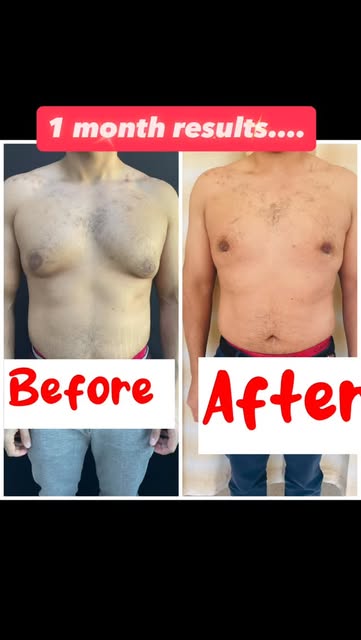 #gynecomastia #liposuction #bestplasticsurgeonbahrain #confidenceboost #drmadhuplasticsurgeon