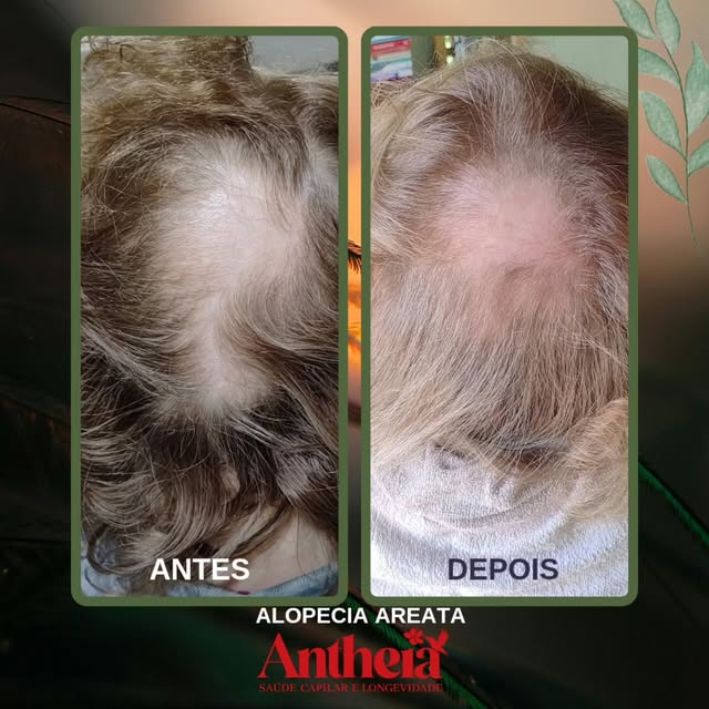 A alopecia areata é uma doença autoimune. Isso significa que o sistema imunológico, por engano, pass