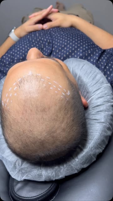 DFW — Tired of worrying about thinning hair or a receding hairline?

Scalp Micropigmentation (SMP) c