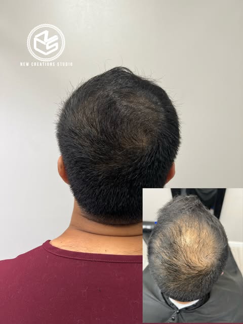 Thinning at the crown? 👑

SMP can help create the appearance of more density and a fuller crown whi