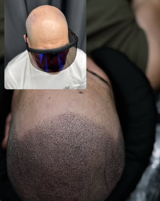 This client shared with us how his hair loss affected the way he felt going to parties, church, and 