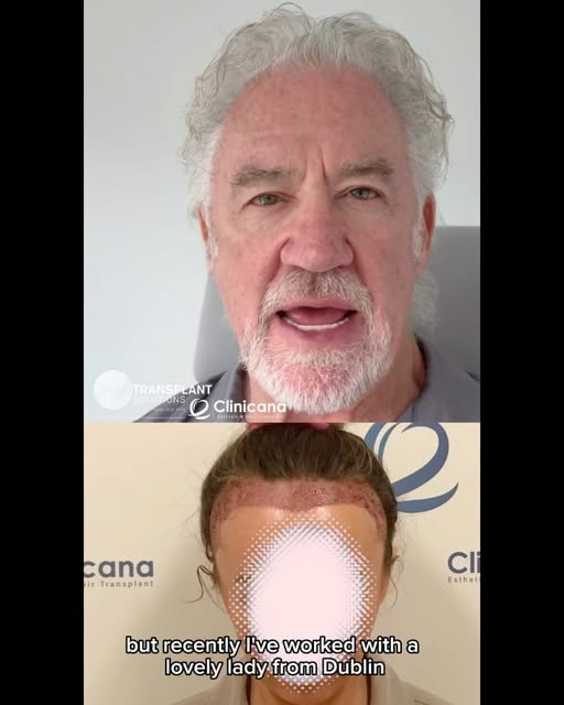 It’s rare we get to share female hair transplant results, as most women understandably keep it priva