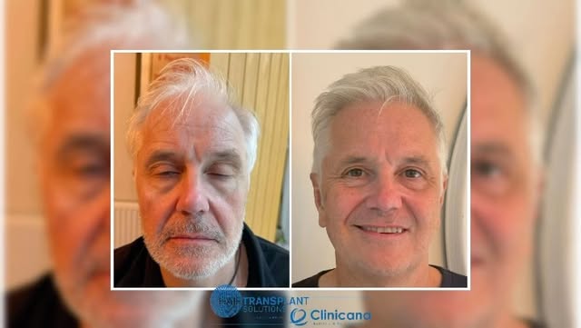 White hair, spectacular transformation! 👏🏻

One of my guys had his hair transplant last October, a