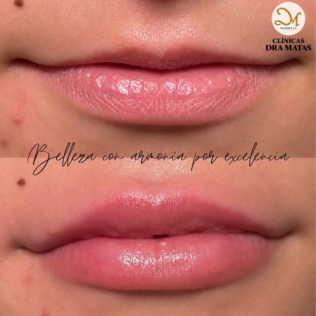 ✨ SIMETRÍA LABIAL | Armonía y naturalidad

La simetría labial no busca transformar tus labios, sino 