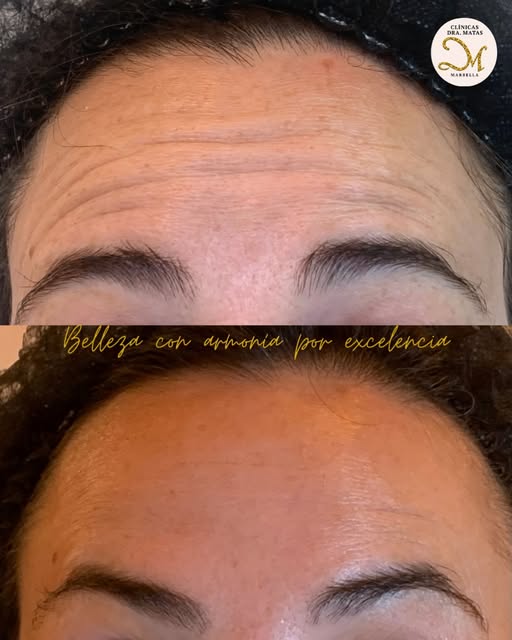 ✨ NATURALIDAD, EXPRESIÓN Y ARMONÍA ✨

Un tratamiento médico para líneas de expresión no tiene por qu
