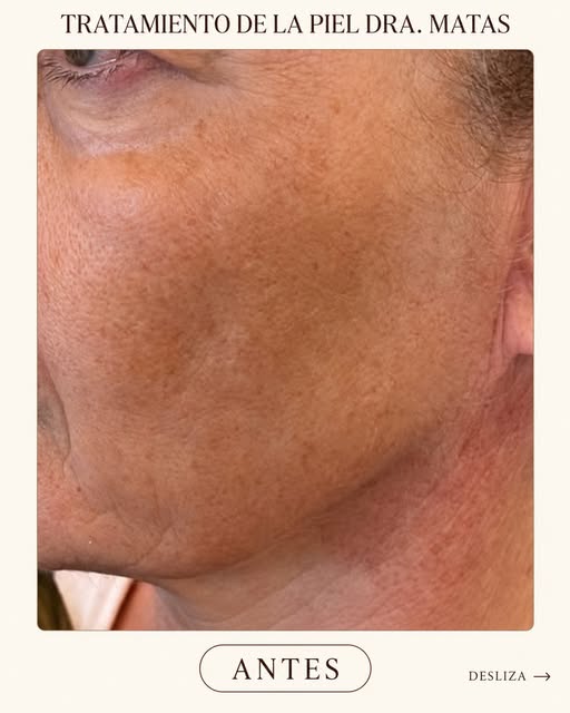 ✨ TRATAMIENTO DE LA PIEL DRA. MATAS

Un protocolo médico exclusivo y personalizado mediante la combi