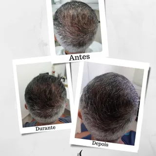Mais caso de sucesso passando em sua telinha ❤️😍🥰.

#clinicasaúdedocabelo #alopecia #bemestar
