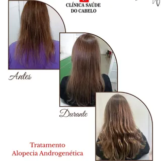 ✨ Transformação real, autoestima renovada!

O tratamento para alopecia androgenética vai muito além 