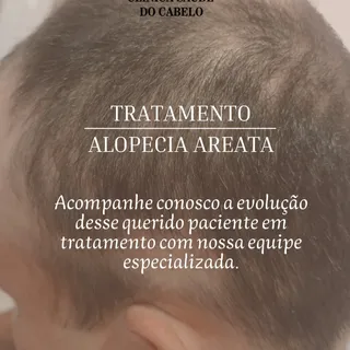 ✨ Resultados que transformam vidas.

#clinicasaúdedocabelo #alopecia #saudecapilar #saudeebemestar