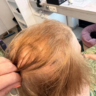 Mooi Haarwerk permanente bevestiging 
Europees haar , infix hair 
#infixhair  #europeeshaar #maatwer