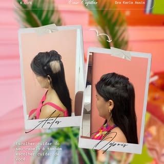 ✨ Alopecia Areata tem tratamento, sim!
⠀
Esse antes e depois fala por si só.
Quando tratamos a causa