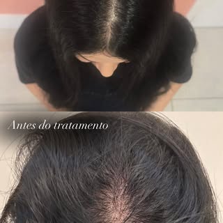 Alopecia androgenética de padrão feminino não é só sobre afinamento  do cabelo, e quedas capilares a