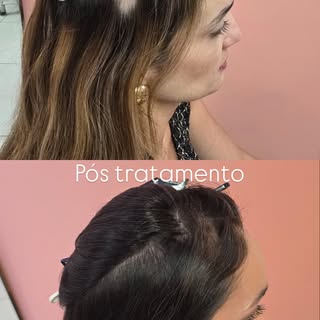 A alopecia areata é uma condição autoimune que causa queda de cabelo em áreas específicas do couro c