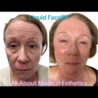 Want to have that refreshed look without the downtime of a surgical facelift?  A liquid facelift wou