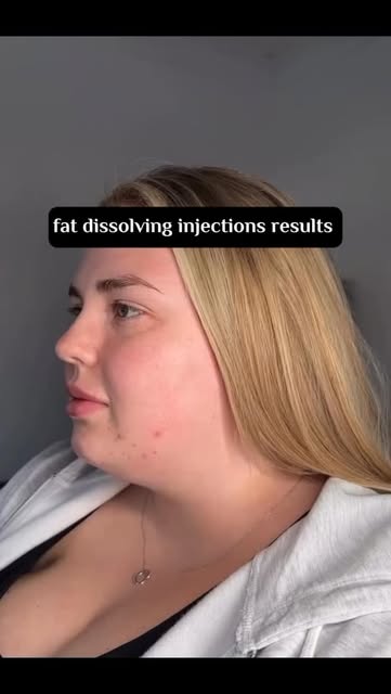 Target stubborn areas with fat dissolving injections ✨
A non-surgical treatment designed to help con