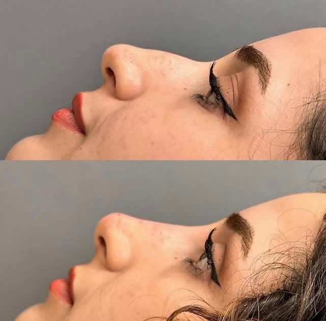 A subtle transformation with nose filler ✨

Strategically placed dermal filler helped smooth the bri