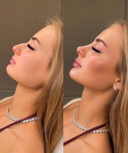 A little enhancement, a lot of confidence ✨💉

Subtle profile balancing with filler to enhance natur