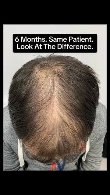 Hair restoration is a journey ,and consistency matters. ✨

This 6-month progress shows a visible imp