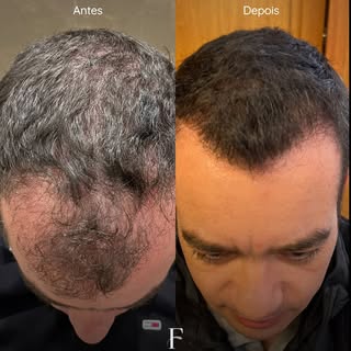 Neste caso, a alopecia androgenética já apresentava sinais clássicos: retração da linha frontal, ent