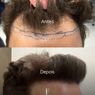 Mais um ANTES e DEPOIS com naturalidade, proporção estética e harmonia!