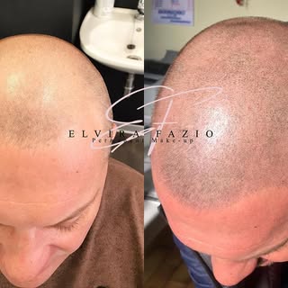 Tricopigmentazione 
#scalp #tricopigmentazione #torino #milano #tricologia