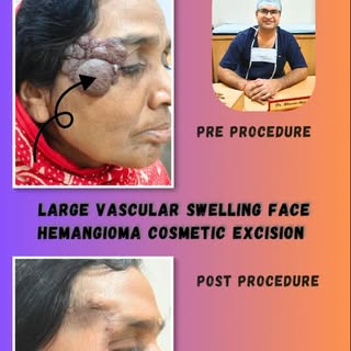 A face once hidden by a giant vascular hemangioma…
High-risk excision. Precision cosmetic reconstruc