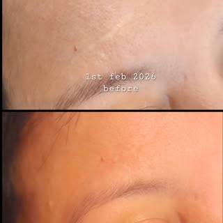 Inkless Skin Revision 

This result is a scar healed over 4 sessions of Inkless Skin Revision (ISR),