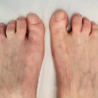 From lifelong self-consciousness to confident feet 👣✨

This client was born with syndactyly (webbed