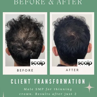 Struggling with a thinning crown? 😔 

This transformation shows what just 2 SMP sessions can do. Na
