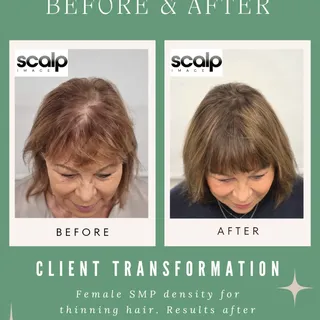 She was starting to notice her thinning hair more... 

Now look at the difference 😱 

SMP has broug