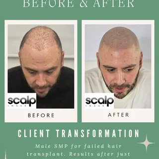 Fantastic results for this client! 😱 

This client previously had a hair transplant which unfortuna