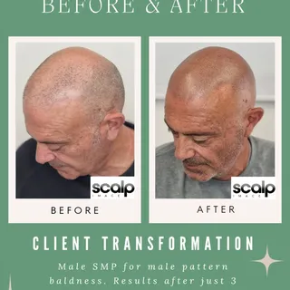 SMP for male pattern baldness 🔥 

This client was struggling with hair loss and was searching for t