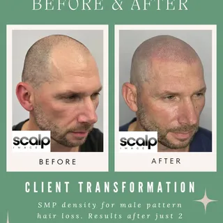 Look at this transformation! 👀 

This client came to us, looking for a solution to his male pattern