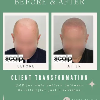 Struggling with male pattern baldness? 

Look at the difference SMP can make. Natural results, no su