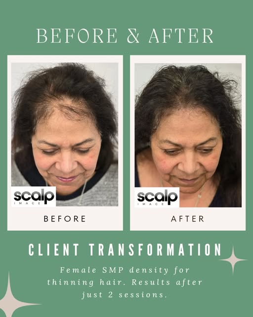 Look at these results! 🔥

This client came to us struggling with thinning hair and the impact it wa