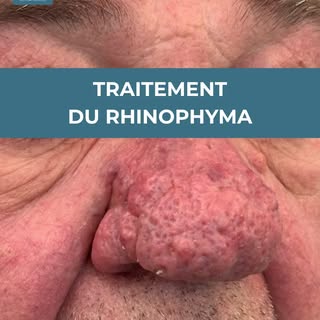 Traitement du rhinophyma au laser CO₂ ultrapulsé 🔬

Le rhinophyma se caractérise par un épaississem
