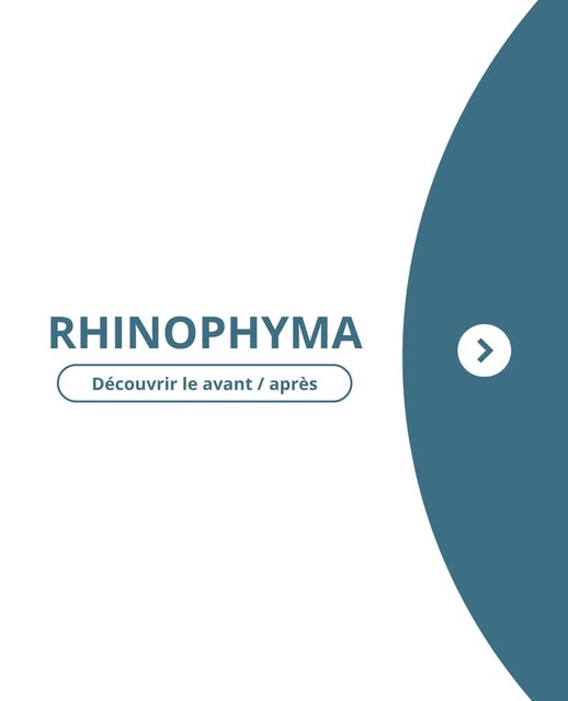 Traitement du rhinophyma à Lyon par laser CO₂ ultra-pulsé 👃🏼

Le laser CO₂ ultra-pulsé permet de t