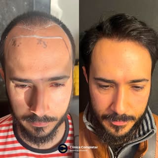 O resultado fala por si. 👏

Cada transplante capilar é planejado para respeitar os traços e a anato