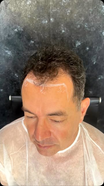 O impacto de um transplante capilar não para no cabelo chega no rosto inteiro.

Linha frontal no lug