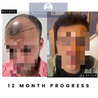 12 month Transformation | FUE Hair Transplant combined with PRP (plasma rich protein) therapy for fa