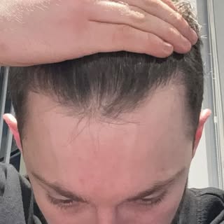 Take a listen to one of our clients sharing their experience at the Yorkshire Hair Surgeons Clinic.
