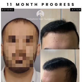 11 month post Hair Transplant results. 
Natural and dense coverage and only 11 months into their jou