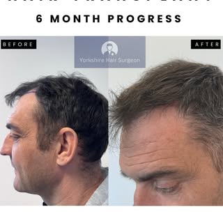 ✨ 6 Months Transformation 
A restoration of the hairline and temple points using 2000 carefully plac