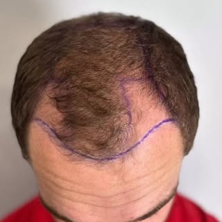 Another 2 week post transplant result. Showing some healthy early progress. 
From our clinic to the 