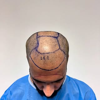 2 weeks post-op — FUE Hair Transplant

Regular follow up and aftercare is provided to all our client